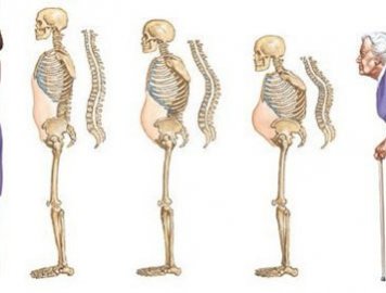 Loãng xương sau sinh